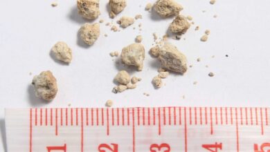 Antibiotics linked to increased risk of kidney stones