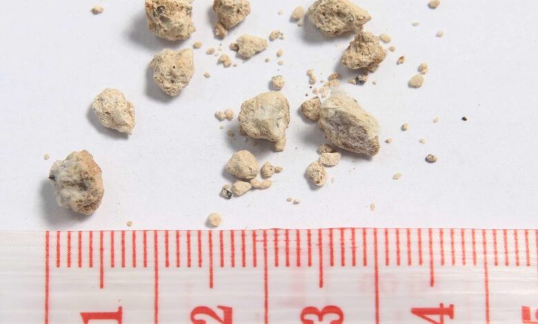 Antibiotics linked to increased risk of kidney stones