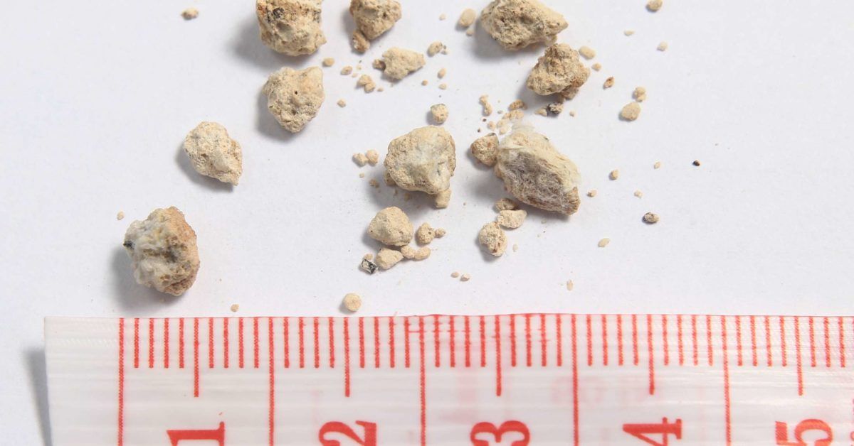 Antibiotics linked to increased risk of kidney stones