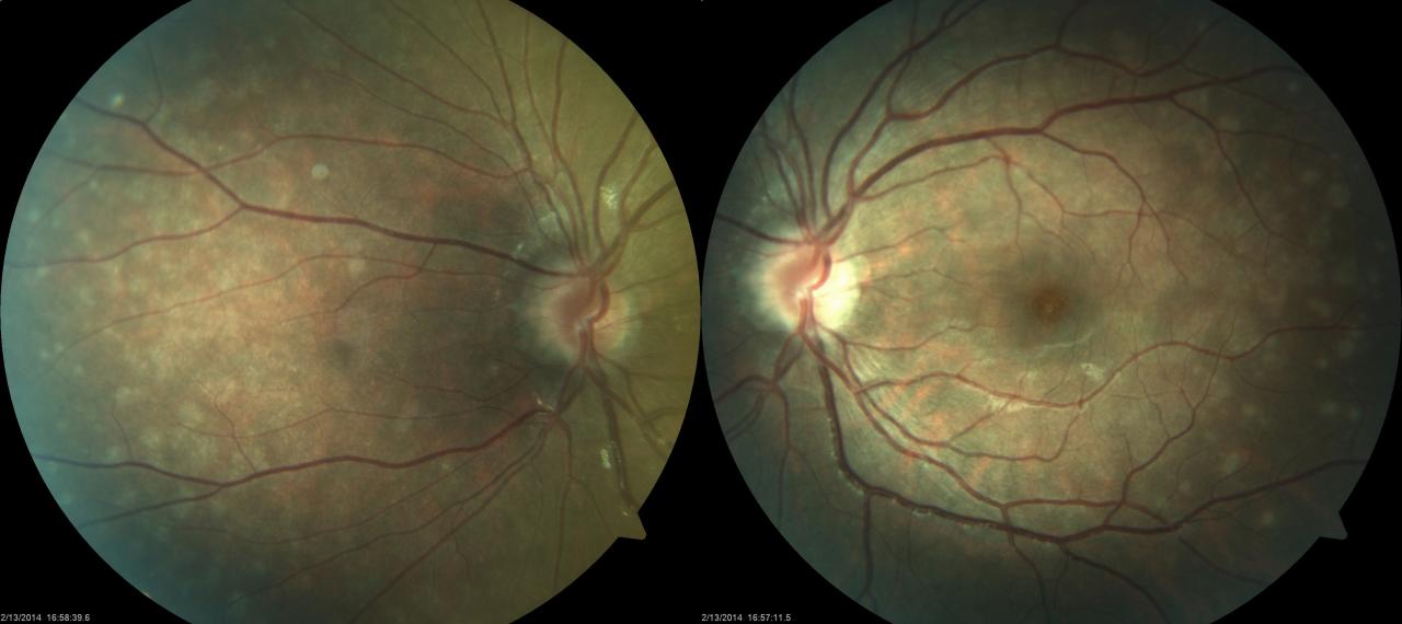 First case of white dot syndrome emerged after covid 19 vaccine and subsequent infection study shows