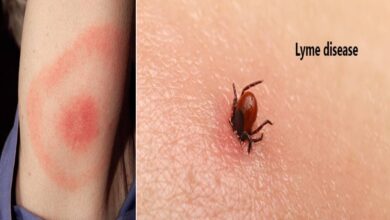 The essential guide to lyme disease symptoms causes treatments and natural approaches