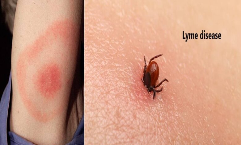 The essential guide to lyme disease symptoms causes treatments and natural approaches