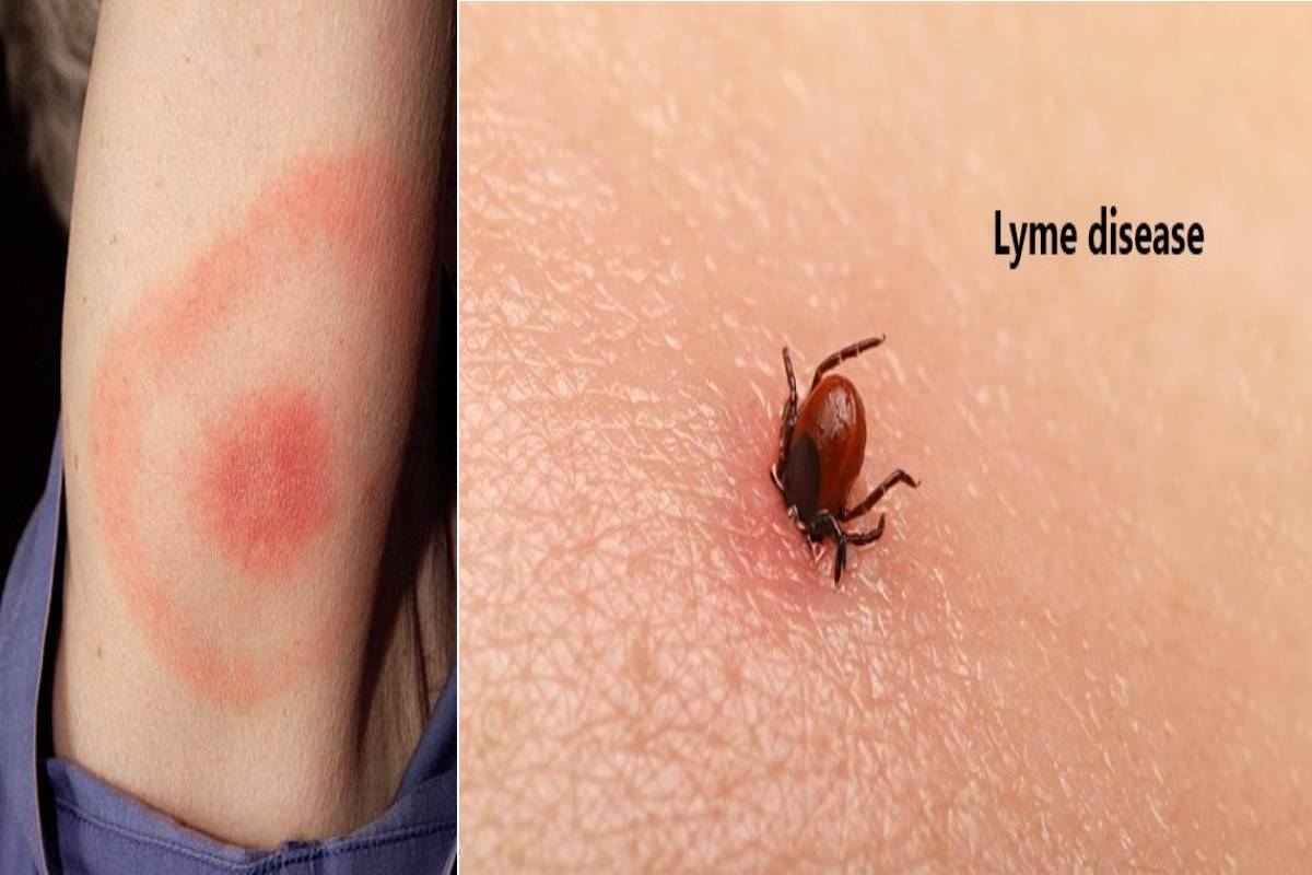 The essential guide to lyme disease symptoms causes treatments and natural approaches