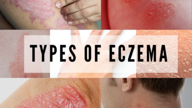 5 main causes of eczema and how to heal naturally through diet