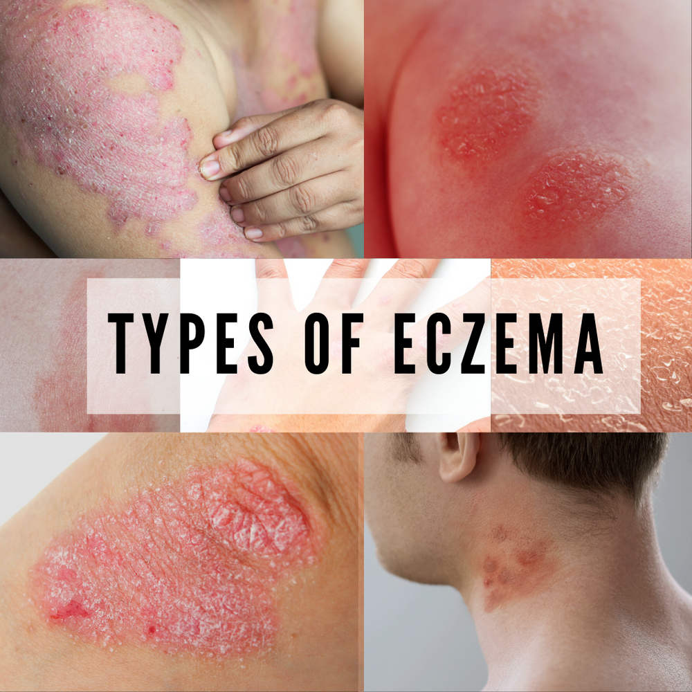 5 main causes of eczema and how to heal naturally through diet