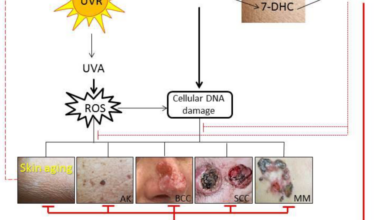 Vitamin d reduces risk of melanoma and other skin cancer study