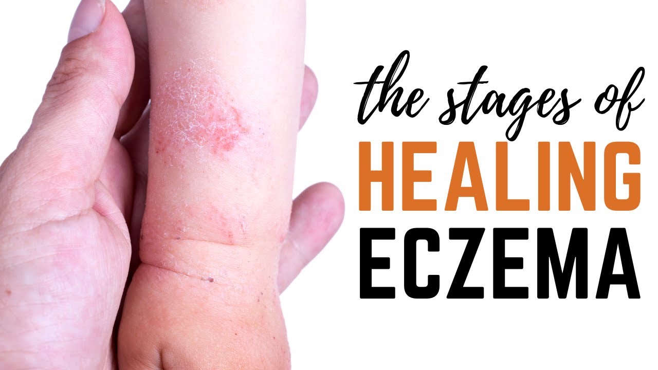 5 main causes of eczema and how to heal naturally through diet