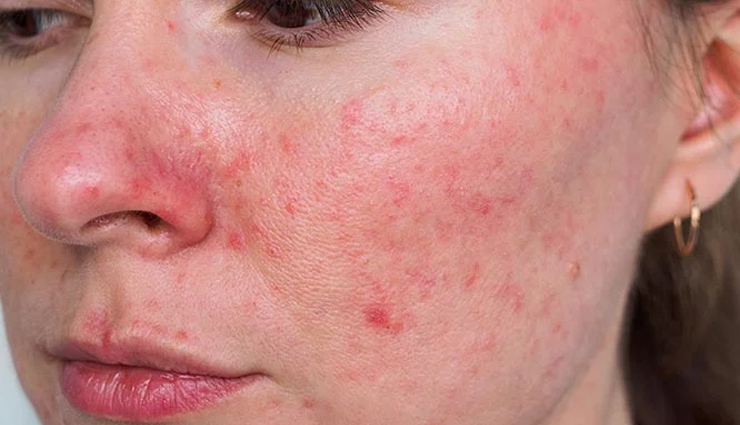 Rosacea symptoms causes treatments and natural approaches